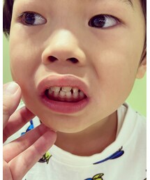 癒合歯治療完治🥺🦷👏🏻 | その他