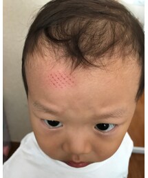 📷オデコ | イスから落ちてジュータンのあと型の内出血👽(その他)