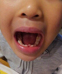 娘☆初歯抜け | やっと抜けた歯✨これから歯磨き頑張らなきゃ💪(その他)