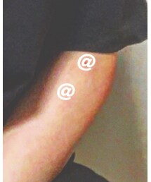 蚊に刺され | その他