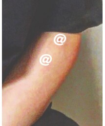 蚊に刺され | その他