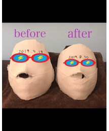 お顔のビフォーアフター✨ | 左右対称になって小さくなったよ♡(その他)