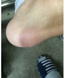 かかと踏まれた | その他