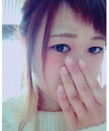 しもやけ | その他