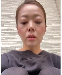 向かって右腫れてる | その他