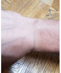 日焼け、手袋の跡😫 | お見苦しくて申し訳ありません🙇(その他)