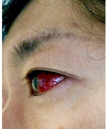 🚑🏥目👁流血❓充血⁉️ | その他