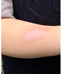 火傷にはモイストヒーリング | その他